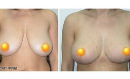 Фото до и после редукционной пластики груди