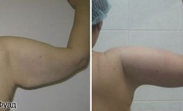 Фото до и после липосакции плеч