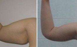 Фото до и после операции подтяжки плеч