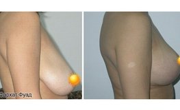 Фото до и после операции редукционной маммопластики