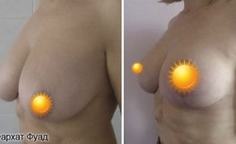 Фото до и после пластики по уменьшению размера груди