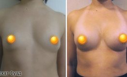 Фото до и после маммопластики круглыми имплантатами объемом 275 мл