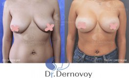 Фото до и после мастопексии