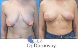 Фото до и после подтяжки груди без имплантов 