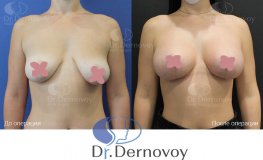 Фото до и после увеличение груди с имплантами