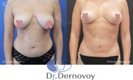 Фото до и после редукционной мастопексии с коррекцией асимметрии