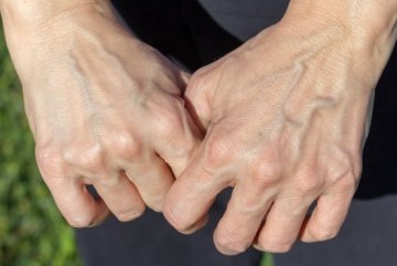 Скелетизация кистей рук. Как бороться с «ужасной» проблемой?