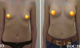 Фото до и после увеличения груди с использованием силиконовых имплантатов