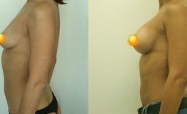 Фото до и после увеличения груди с использованием имплантатов объемом 350 мл