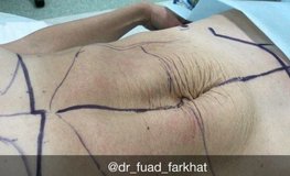 Фуад Фархат - Диастаз прямых мышц живота