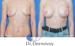 Фото до и после пластики груди