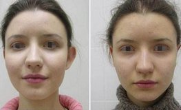 Фото до и после изменения формы уха операцией отопластика