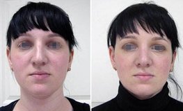 Фото до и после коррекции формы носа с исправлением перегородки 