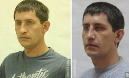 Фото до и после операции по поводу посттравматической деформации носа