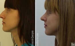 Фото до и после редукционной пластики носа и стабилизации кончика носа