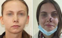 Фото до и после реконструкции наружного носа