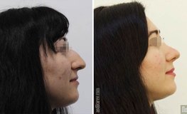 Фото до и после устранения горбинки носа, имиджевой риносептопластики