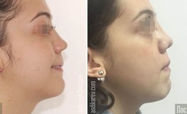 Фото до и после повторной ринопластика, ротации кончика носа