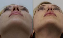 Фото до и после имиджевой риносептопластики с сужением спинки носа