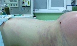 Русиф Мамедов - Видео результатов липофилинга ягодиц