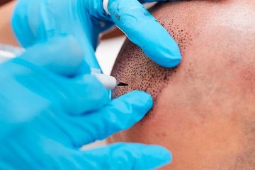 Лечение Scalp Micro-Pigmentation позволяет замаскировать облысевшие части головы