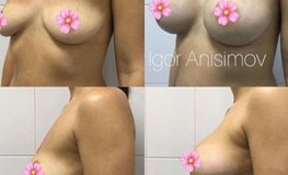 Фото до и после аугментационной маммопластики (увеличение объема молочных желез)