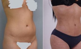 Фото до и после липоскульптуры тела 