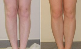 Фото до и после исправления кривизны ног 