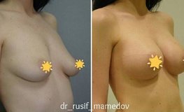 Фото до и после эндопротезирования груди имплантатами компании Ментор