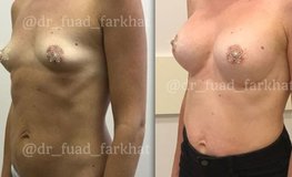 Фото до и после увеличения груди с подтяжкой