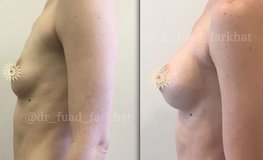 Фото до и после увеличения груди (маммопластика)