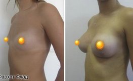 Фото до и после эндопротезирования груди имплантатами объемом 290 мл
