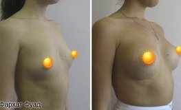 Фото до и после маммопластики грудными имплантатами анатомической формы