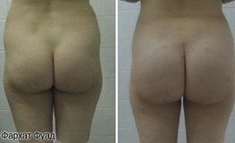 Фото до и после операции по коррекции ягодиц (глютеопластика)