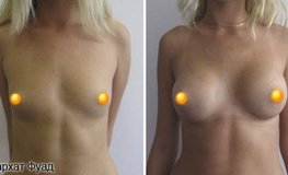 Фото до и после эндопротезирования груди круглыми имплантатами по ареоле