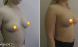 Фото до и после маммопластики грудными имплантатами объемом 310 мл