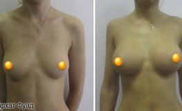 Фото до и после маммопластики грудными имплантатами объема 280 мл