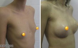 Фото до и после операции по увеличению груди имплантатами с объемом 320 мл