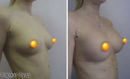 Фото до и после операции маммопластики имплантатами 330 мл