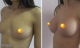 Фото до и после маммопластики грудными имплантатами объемом 380 мл