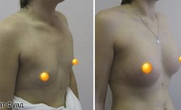 Фото до и после увеличения груди имплантатами объемом 340 мл