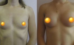 Фото до и после увеличения груди небольшими имплантатами