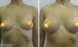Фото до и после эндопротезирования грудных желез имплантатами объемом 315 мл
