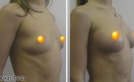 Фото до и после операции по увеличению груди имплантатами объема 270 мл