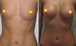 Фото до и после увеличения груди у нерожавшей девушки с использованием имплантатов 