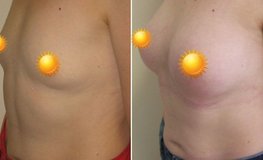 Фото до и после маммопластики груди, установка имплантата сосково-ареолярным методом
