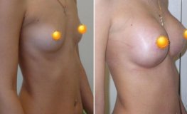 Фото до и после маммопластики при помощи анатомических имплантатов