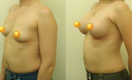 Фото до и после увеличения груди с использованием каплевидных имплантатов