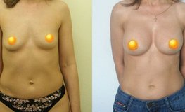Фото до и после увеличения груди силиконовыми имплантатами объемом 350 мл