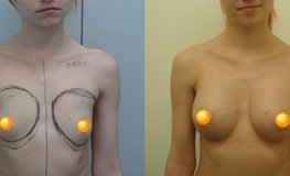 Фото до и после увеличения молочных желез при помощи эндопротезов